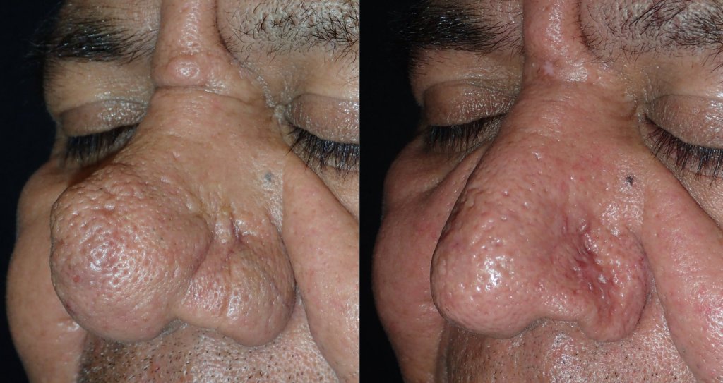 Before and After Nose Surgery