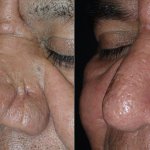 Before and After Nose Surgery