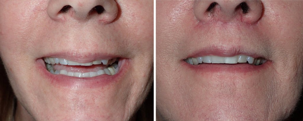 Before and After Lip Lift