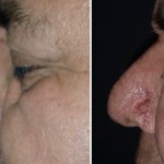 Before and After Nose Surgery