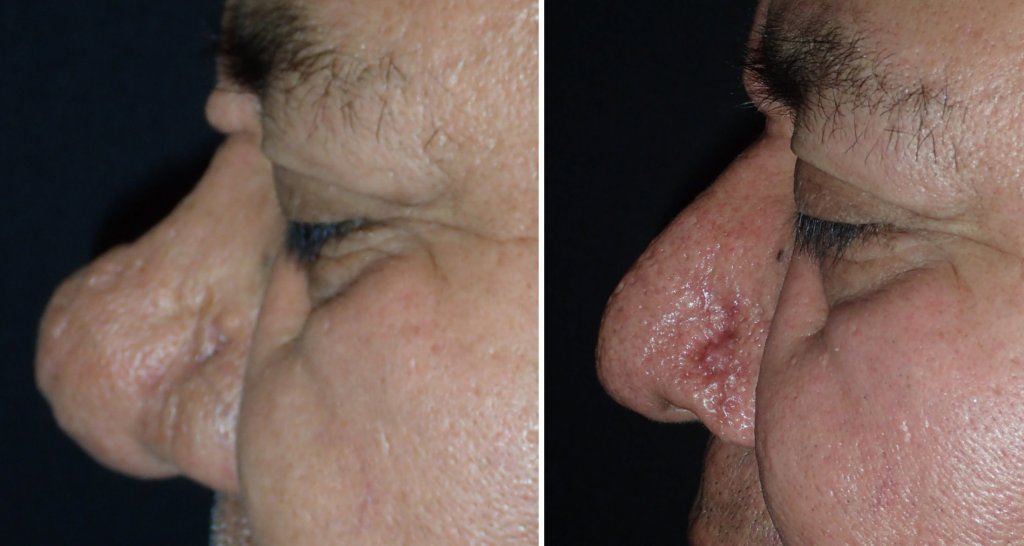 Before and After Nose Surgery