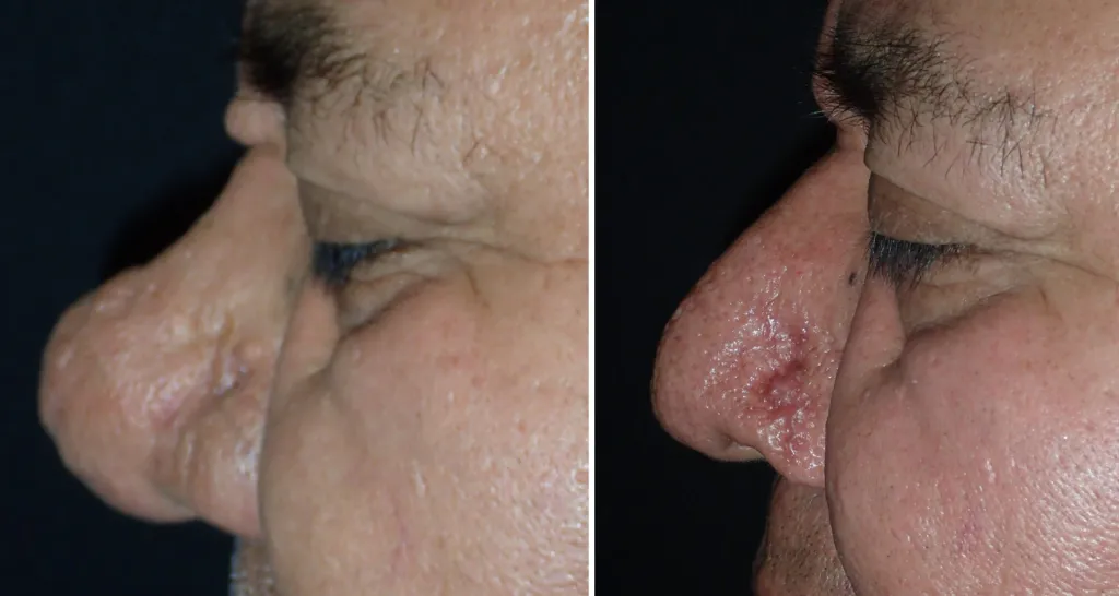Before and After Nose Surgery
