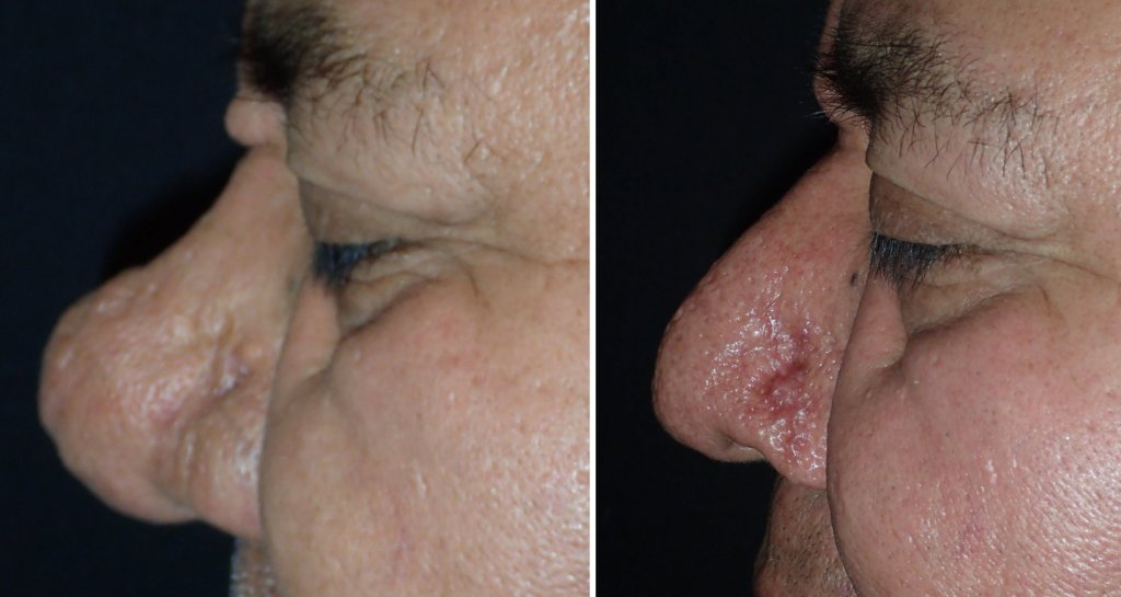 Before and After Nose Surgery