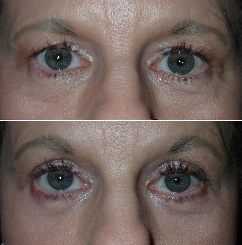 Before and After Eyelid Surgery