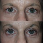 Before and After Eyelid Surgery