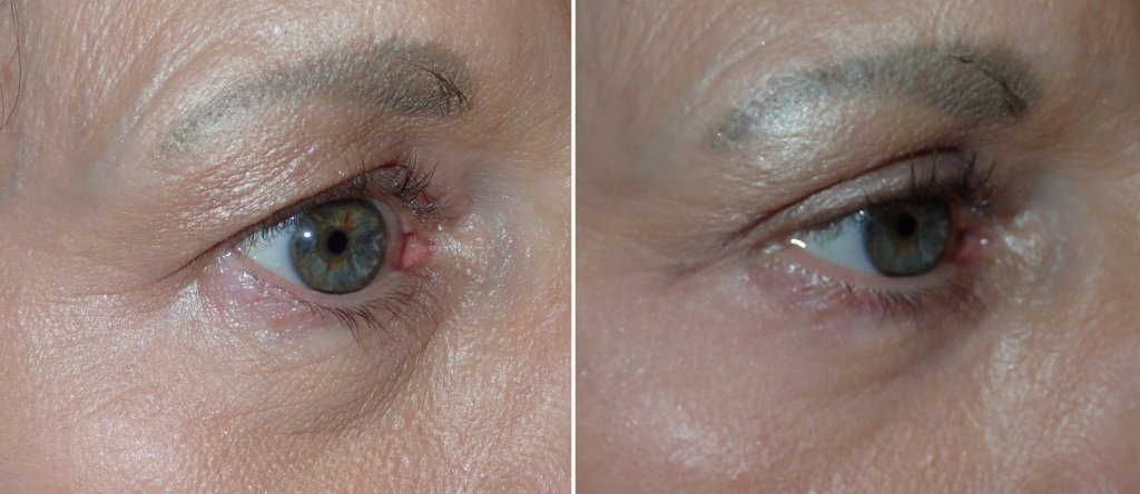 Before and After Eyelid Surgery