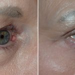 Before and After Eyelid Surgery
