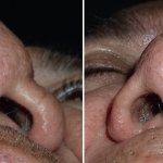 Before and After Nose Surgery