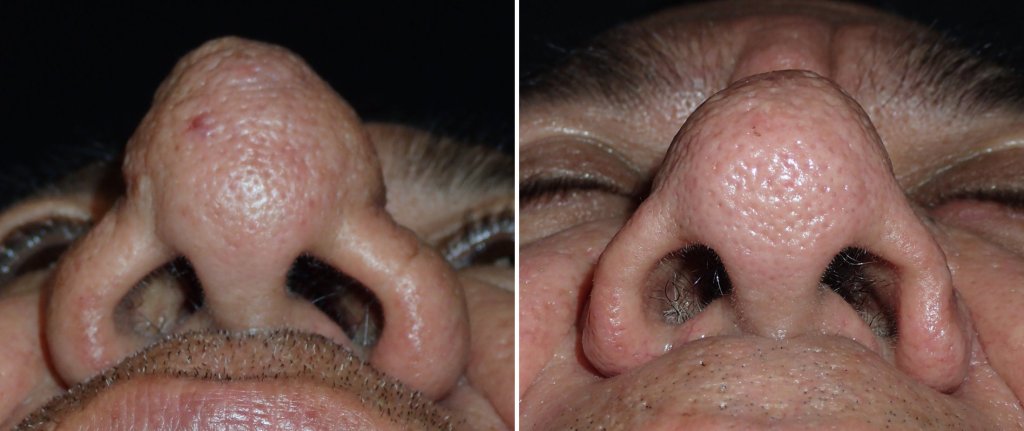 Before and After Nose Surgery
