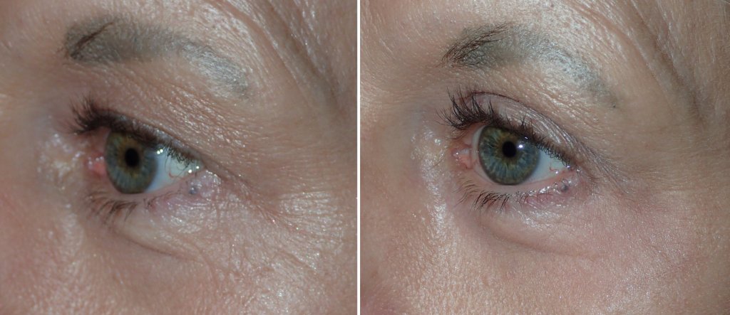Before and After Eyelid Surgery