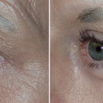 Before and After Eyelid Surgery