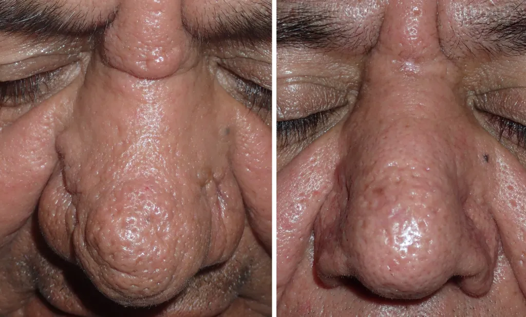 Before and after photos showing closer shot of Rhiniophyma