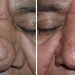 Before and After Nose Surgery