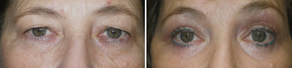 Eyelid Surgery in Richmond, VA