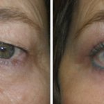 Eyelid Surgery in Richmond, VA