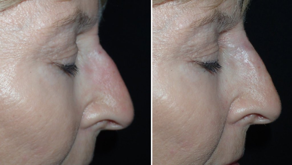 Dr. Niamtu performed elevation of the nasal tip with injectable filler