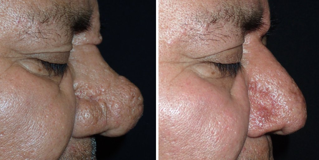 Before and After Nose Surgery