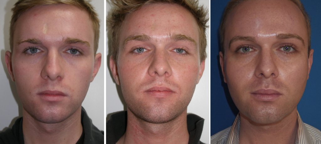 Before and After Cheek Implants