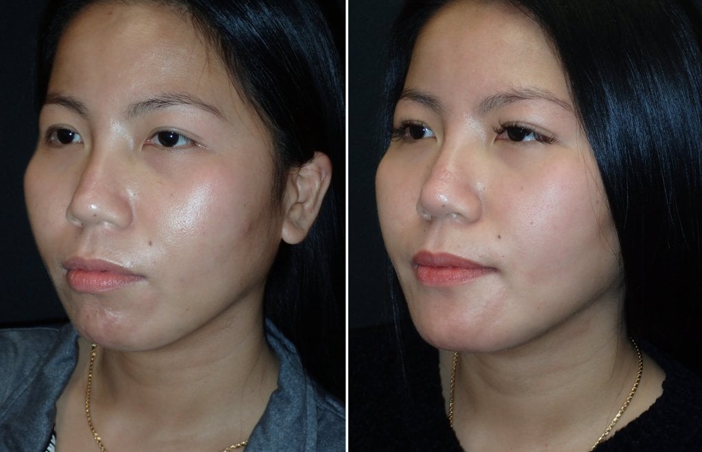 Before and after chin implant, 3/4 view
