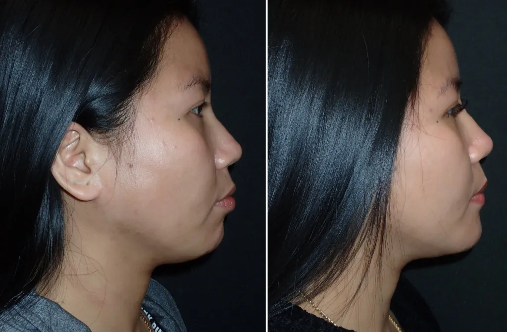 Before and After chin implants, side view