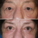 Before and After Eyelid Surgery