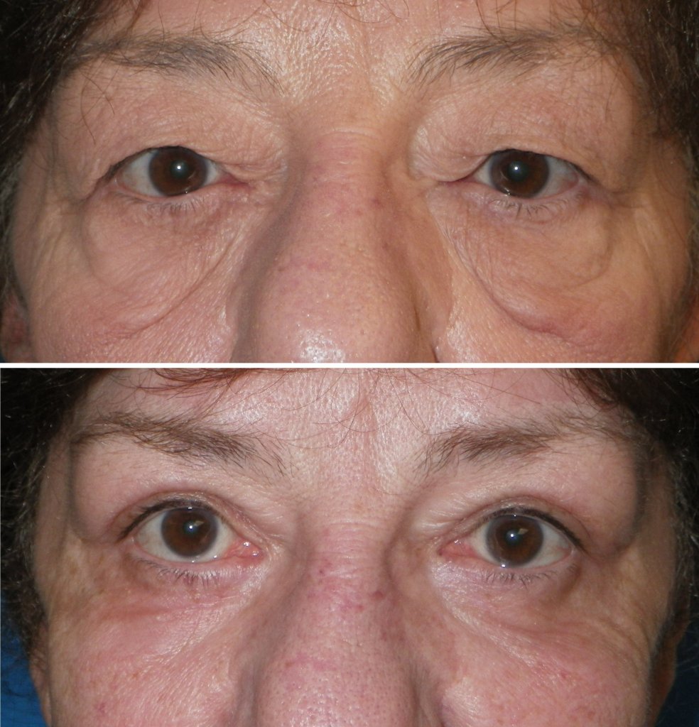 Before and After Eyelid Surgery