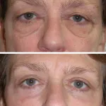 Before and After Eyelid Surgery