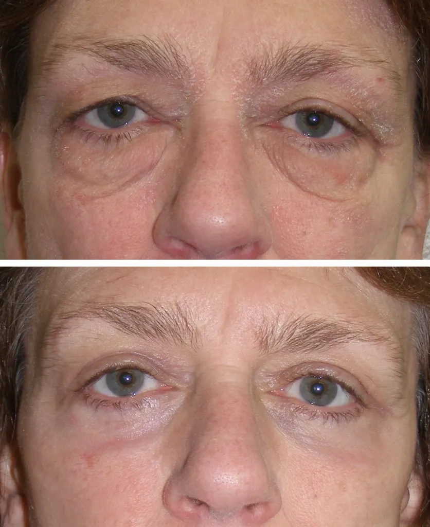 Before and After Eyelid Surgery