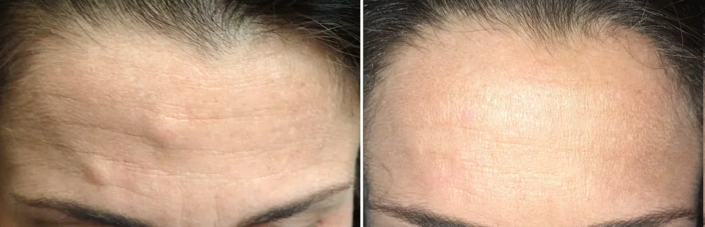 Before and After Forehead Osteoma Removal