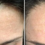 Before and After Forehead Osteoma Removal
