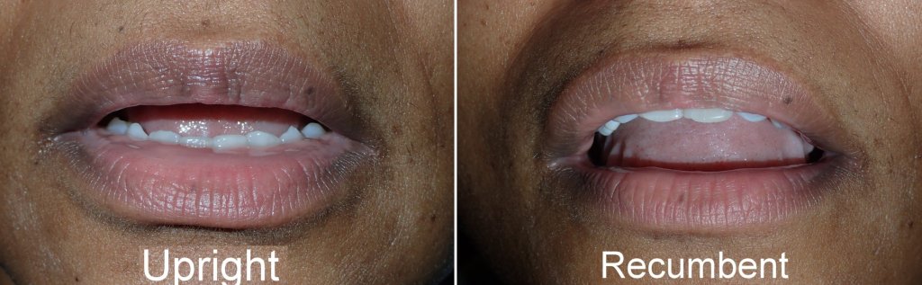 Lip Lift