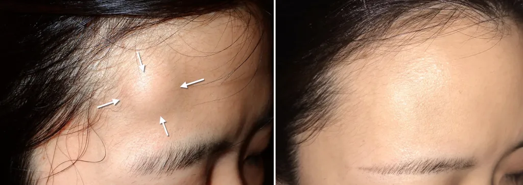 Before and After Forehead Osteoma Removal