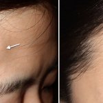 Before and After Forehead Osteoma Removal