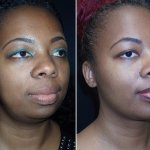 Before and After Neck Rejuvenation