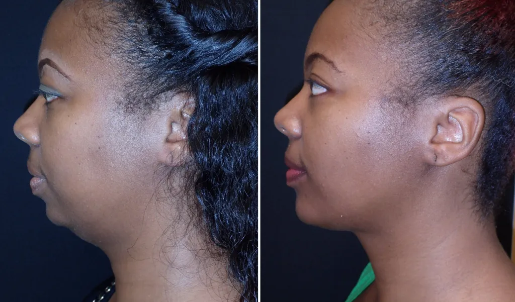 Before and After Neck Rejuvenation, side view