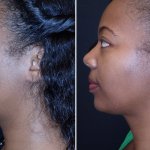 Before and After Neck Rejuvenation, side view