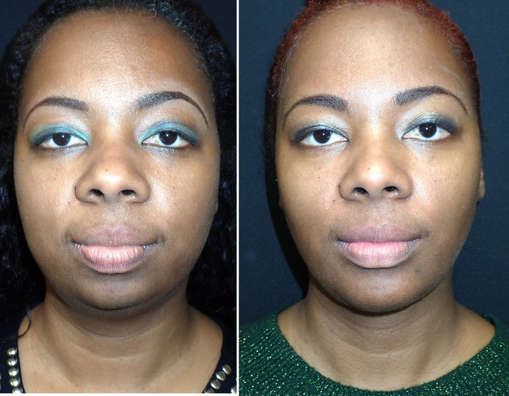 Before & After Neck Rejuvenation