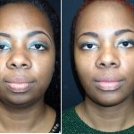 Before & After Neck Rejuvenation