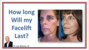 How long will my facelift last?