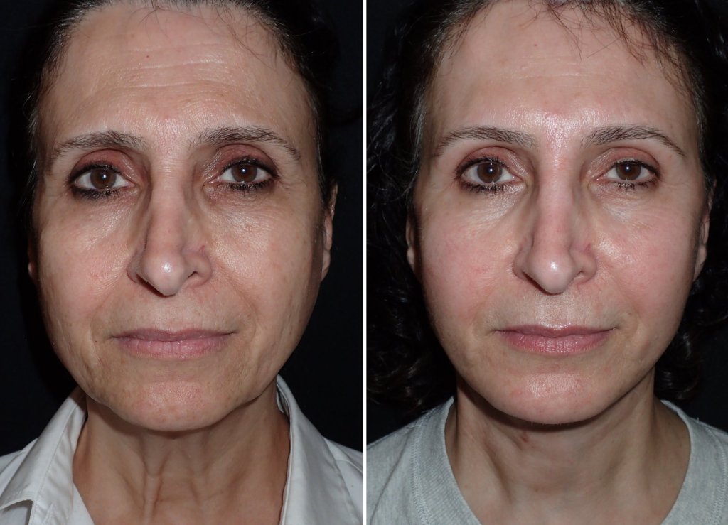 Facelift with combination procedures