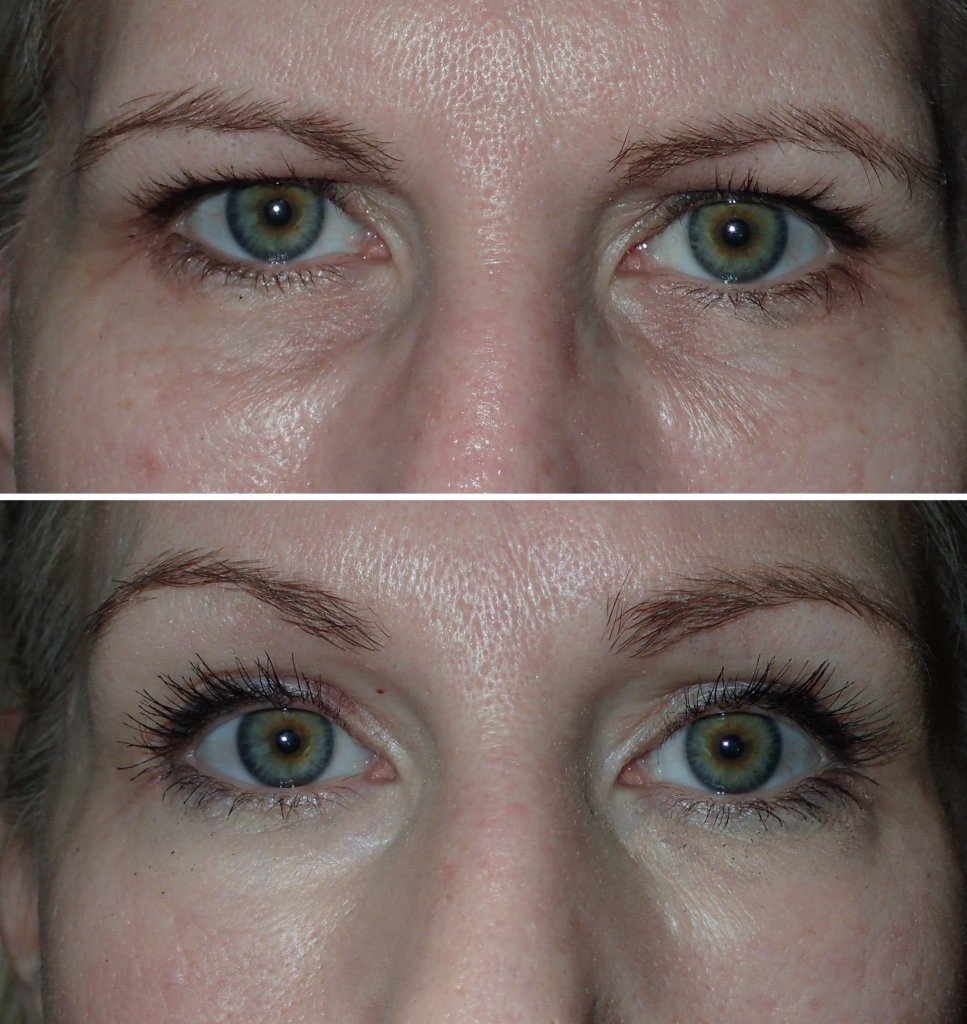 Before and After Eyelid Surgery