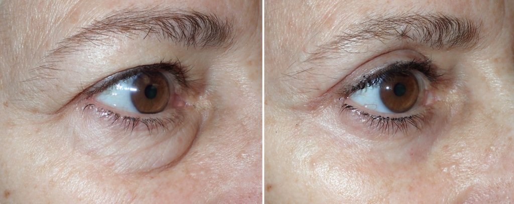 Eyelid Surgery in Richmond, VA