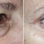 Eyelid Surgery in Richmond, VA