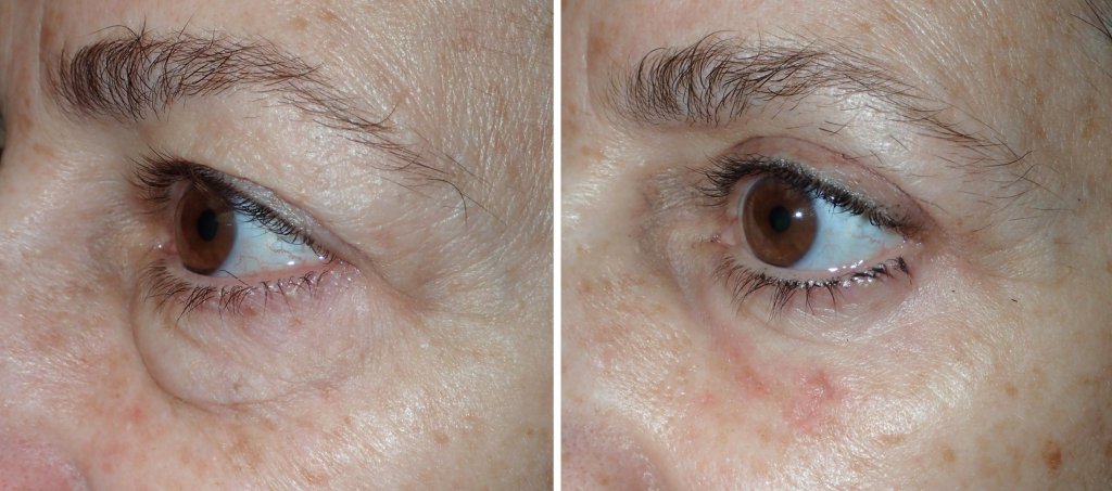 Eyelid Surgery in Richmond, VA