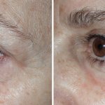 Eyelid Surgery in Richmond, VA