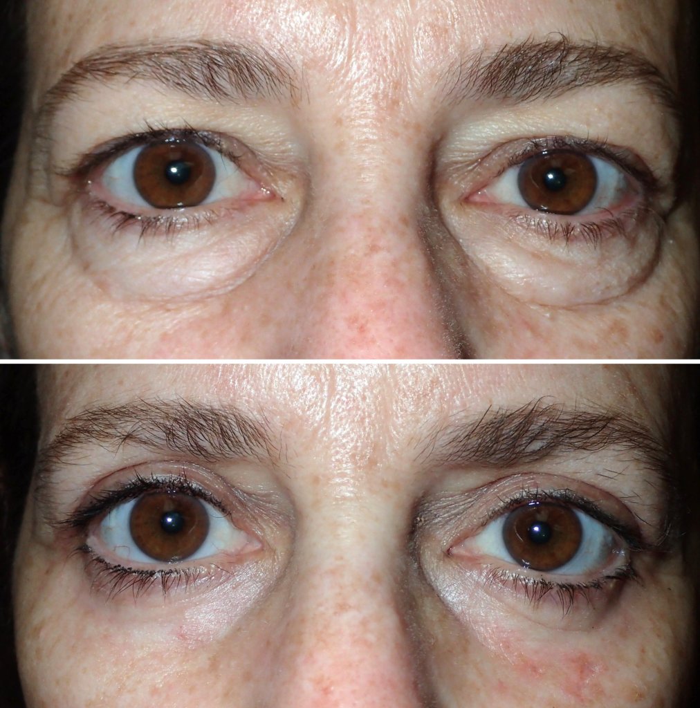 Eyelid Surgery in Richmond, VA