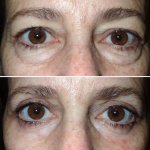 Eyelid Surgery in Richmond, VA