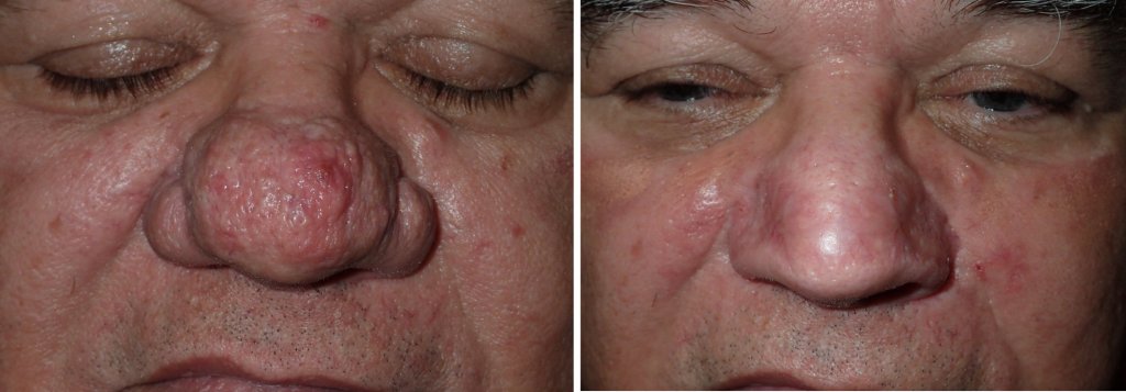 Before and after photos showing Rhiniophyma
