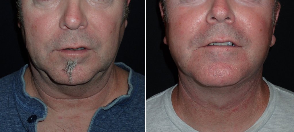 Facelifts for Men in Richmond