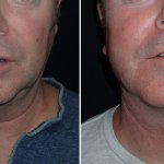 Facelifts for Men in Richmond